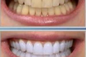 پنج راه حل برای فرار از دندان های زرد